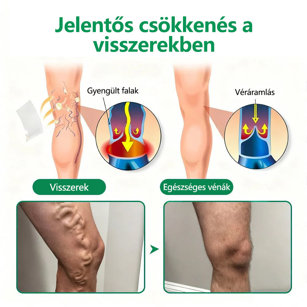 🌿CleraNaure® VeinTarget Mikrotűs Pólya 💎🗽 Azonnali Enyhülés, Hosszú Távú Eredmények