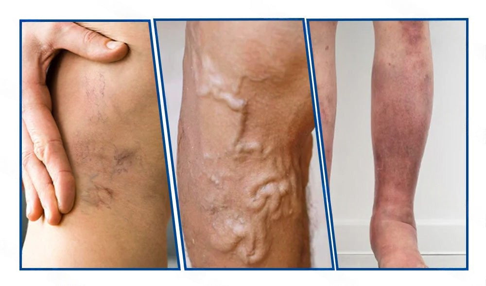 🇭🇺𝐇𝐞𝐚𝐥𝐫𝐢𝐳𝐞® 👩‍⚕️VeinTarget mikrotűs tapasz⚡✅Azonnali enyhülés hosszú távú eredmények