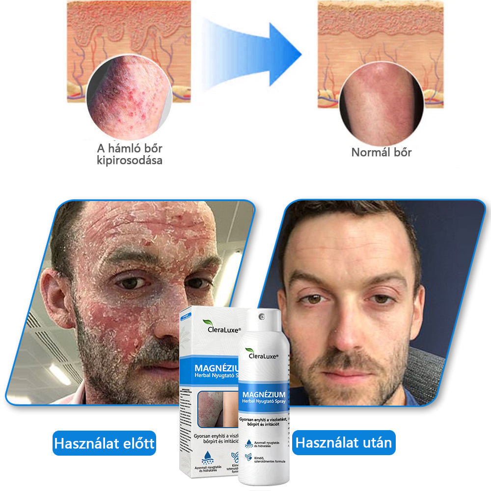 👩🏻‍⚕️CleraNature® Magnéziumos Spray – Gyors Enyhülés Viszkető, Vörös és Érzékeny Bőrre (Még Intim Területeken is)✨✨