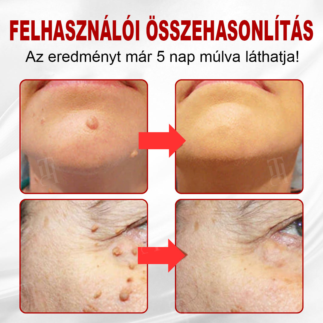 CleraNature® WartAway Pro tapaszok
