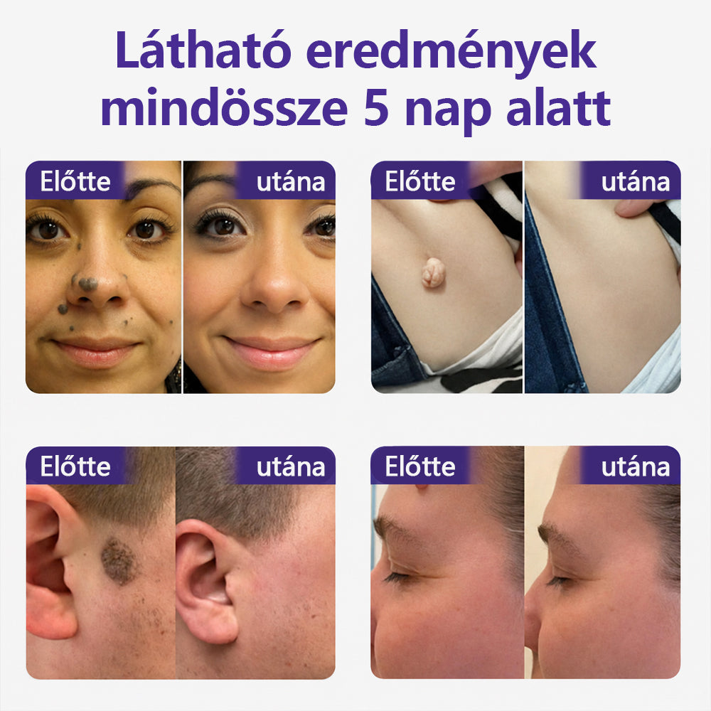 👩🏻‍⚕️👩🏻‍⚕️COLTURE® szemölcs- és anyajegytávolító mikrotűs tapasz🏅✨