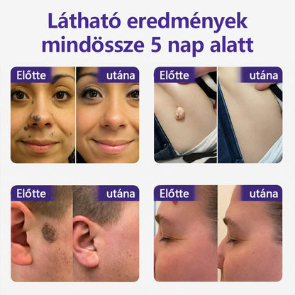 👩🏻‍⚕️👩🏻‍⚕️COLTURE® szemölcs- és anyajegytávolító mikrotűs tapasz🏅✨