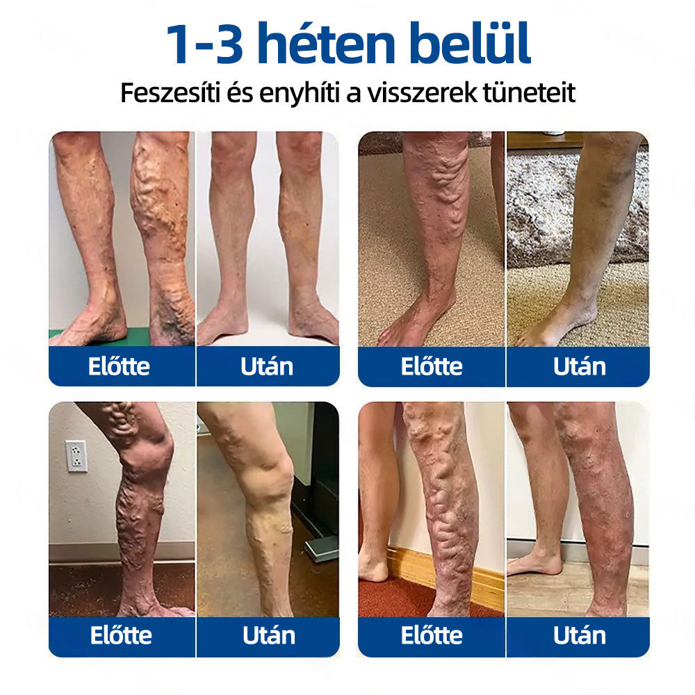 🇭🇺𝐇𝐞𝐚𝐥𝐫𝐢𝐳𝐞® 👩‍⚕️VeinTarget mikrotűs tapasz⚡✅Azonnali enyhülés hosszú távú eredmények