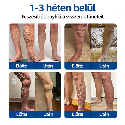 🇭🇺𝐇𝐞𝐚𝐥𝐫𝐢𝐳𝐞® 👩‍⚕️VeinTarget mikrotűs tapasz⚡✅Azonnali enyhülés hosszú távú eredmények