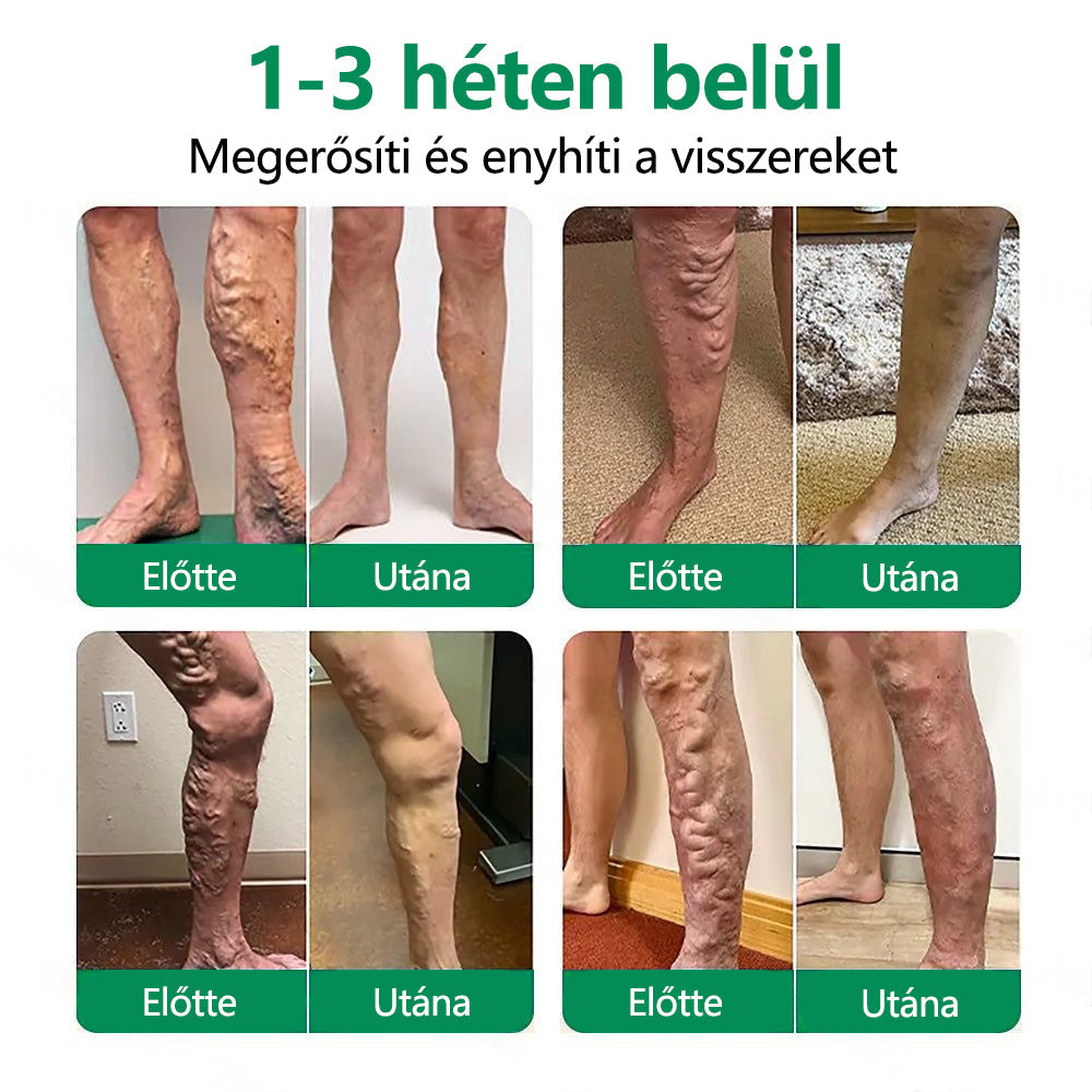 🌿CleraNaure® VeinTarget Mikrotűs Pólya 💎🗽 Azonnali Enyhülés, Hosszú Távú Eredmények