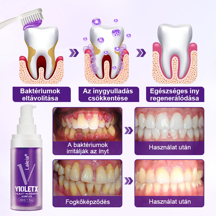 🦷🦷Laleia® VioletX Fejlett Fehérítő Komplex