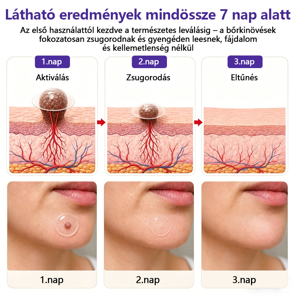 👩🏻‍⚕️👩🏻‍⚕️COLTURE® szemölcs- és anyajegytávolító mikrotűs tapasz🏅✨