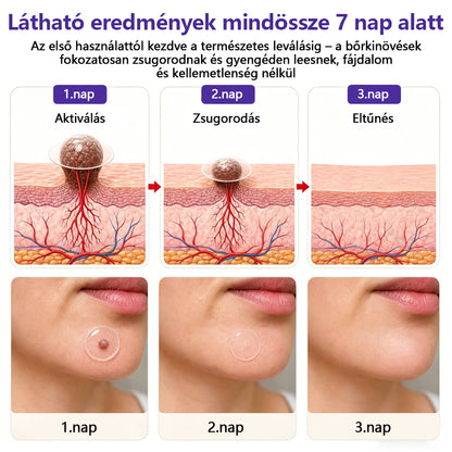 👩🏻‍⚕️👩🏻‍⚕️COLTURE® szemölcs- és anyajegytávolító mikrotűs tapasz🏅✨
