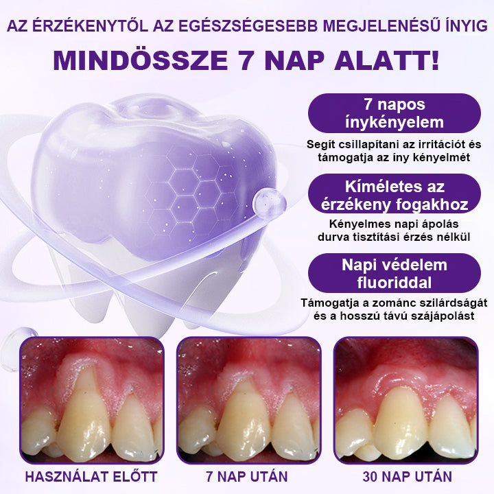 🦷🦷Laleia® VioletX Fejlett Fehérítő Komplex